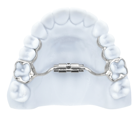 palatal expander